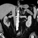 Angiomyolipoma, adenoma, adrenal adenoma, multiple: CT - Computed tomography